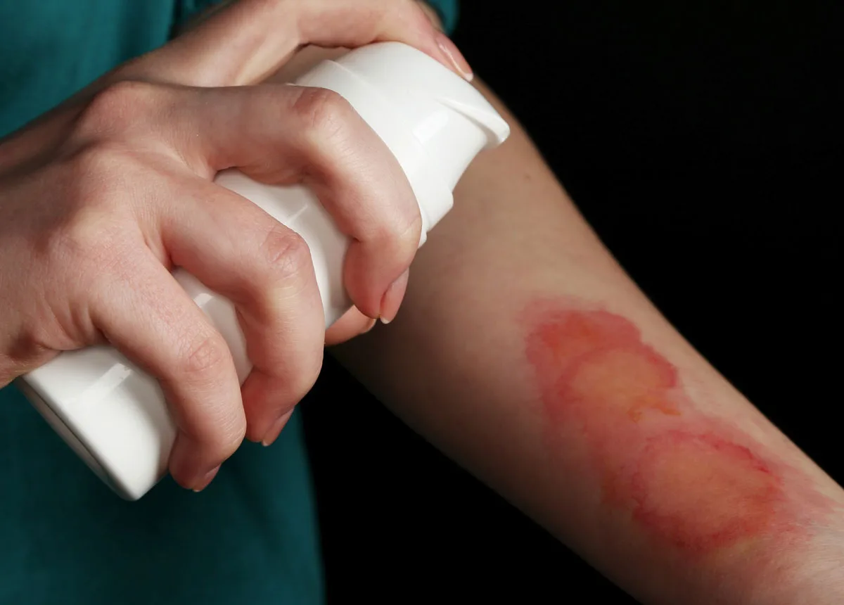 Burn injury cases